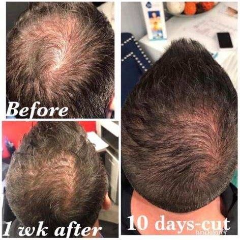 How can exosomes restore your hair? Hair Loss for Men — Pretty Faces Atlanta