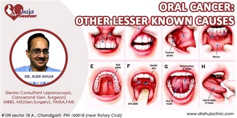 Oral Cancer And Its Causes Cancer Specialist Best Surgeon