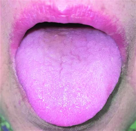 After Stopping Moxifloxacin The Black Hairy Tongue Improved