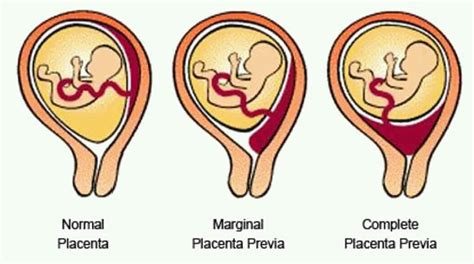 Placenta Previa Drelton Peci