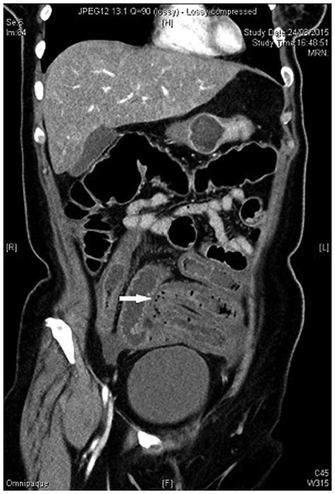 Severe Ileitis Associated With Capecitabine Two Case Reports And