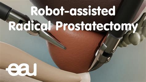 Robot Assisted Radical Prostatectomy Rarp Youtube