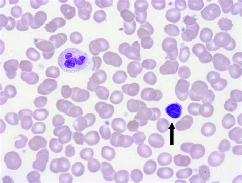 Incidental Finding Of Lymphocytosis In An Asymptomatic Patient The Bmj
