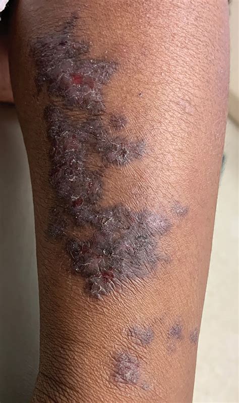 Linear Violaceous Papules In A Child Mdedge Dermatology
