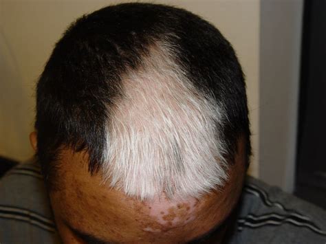 A birthmark under the hair of a different form suggests that its owner is able to manipulate people. White Birthmark Meaning, On Stomach, Hair, Back, Baby ...