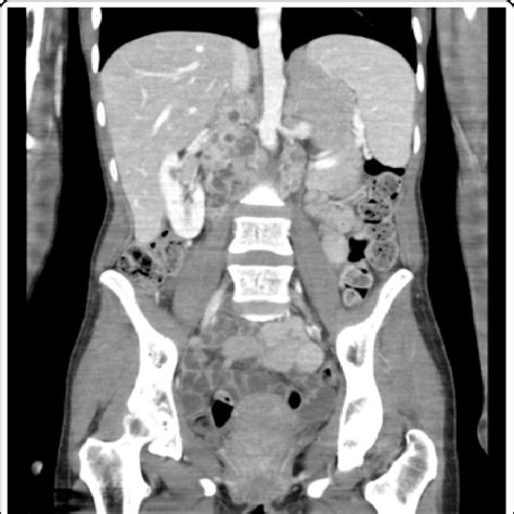 Ct Of The Thorax Abdomen And Pelvis With Contrast Demonstrating A