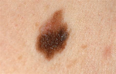 5 Signs Of Skin Cancer Other Than An Abnormal Mole Artofit