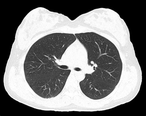 Lung Cancer Screening By Ct Scan Risk Based Vs Uspstf