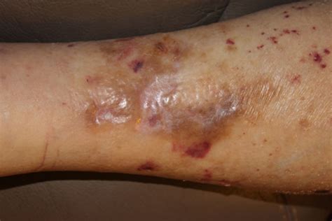 Skin Lesions Lower Leg