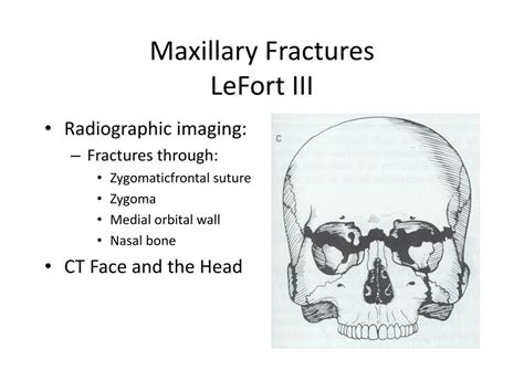 PPT - FRACTURES OF MAXILLA AND MANDIBLE PowerPoint ...