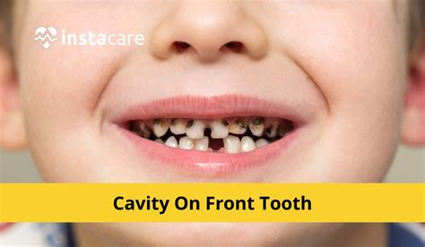 What Causes Cavity On Front Tooth