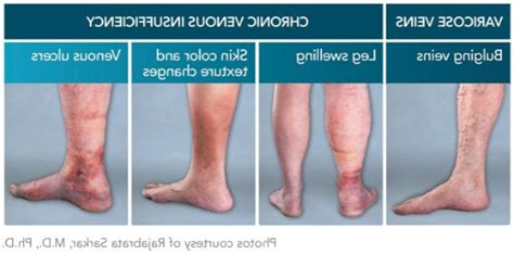 Chronic Venous Insufficiency Treatments Diagnosis And Symptoms In