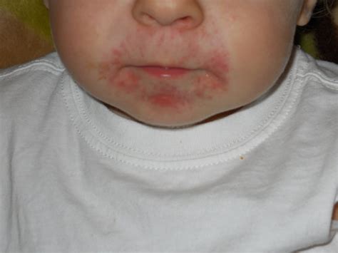 Help Rash On Face Babycenter