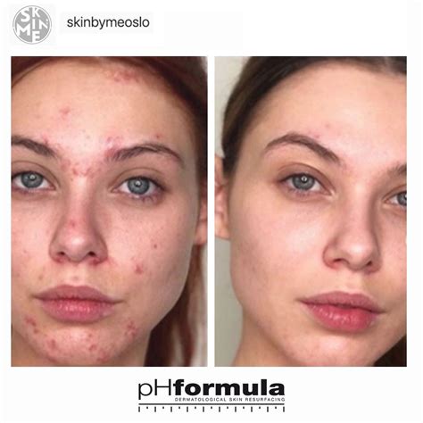 Doctor harmandeep sidhu is known as the best skin specialist in. Excellent acne skin resurfacing results from our pHformula ...