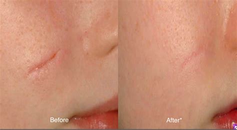 Acne And Surgical Scars Removal Orlando Fl