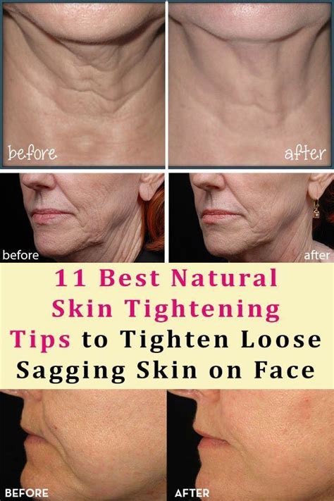 11 Best Natural Skin Tightening Tips To Tighten Loose Sagging Skin On