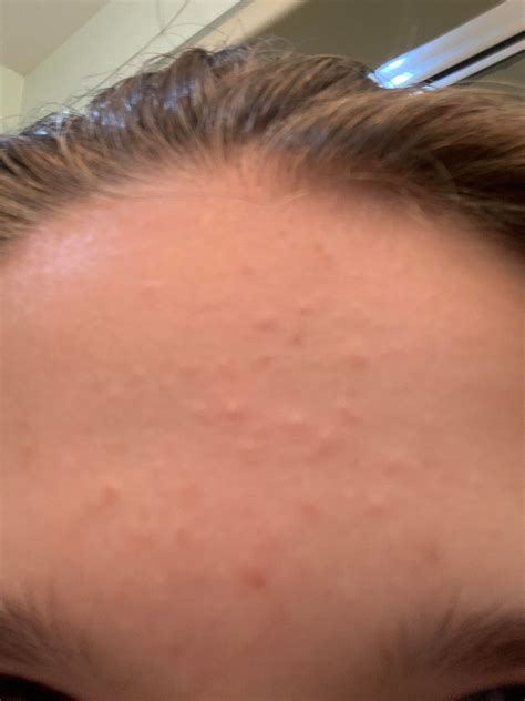 What Are All Of These Bumps On My Forehead And How To I Get Ride Of