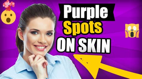 Purple Spots On Skin What You Need To Know Harmless Or Serious