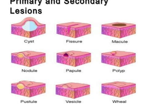 Types Of Skin Lesions Chart