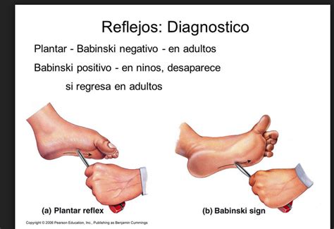 Reflexo De Babinski Em Bebê