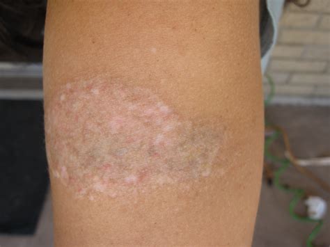 When the scab falls off. Chronicles of a Tattoo Removal: The Second Pass Method?