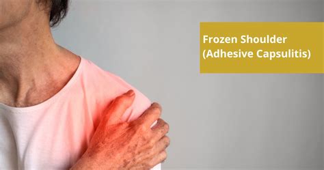 Frozen Shoulder Pain Adhesive Capsulitis Treatment