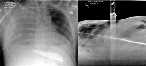 Frontal And Lateral Chest Radiographs Taken In The Resuscitation Room