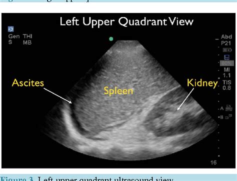 Figure 1 From Ultrasound For Detection Of Ascites And For Guidance Of