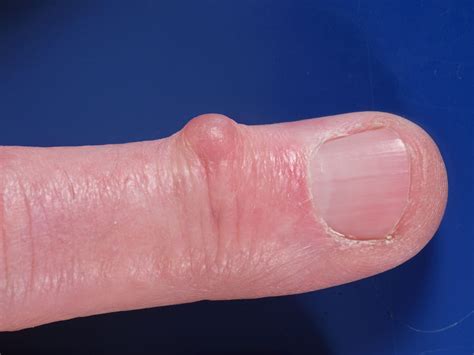 Mucus Cyst