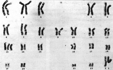 Karyotype Of Trisomy D Chromosome 13 Courtesy By The Laboratory Of Download Scientific