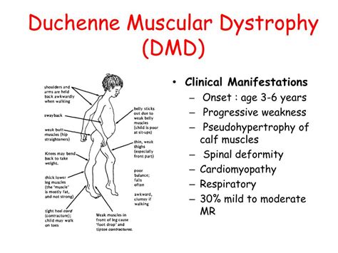 What Is Duchennes Muscular Dystrophy Duchennes Muscular Dystrophy