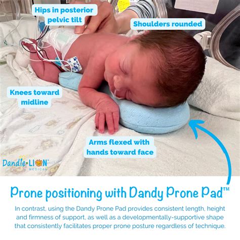 Consistency Is Key Neonatal Positioning For Neurodevelopmental Support DandleLION Medical