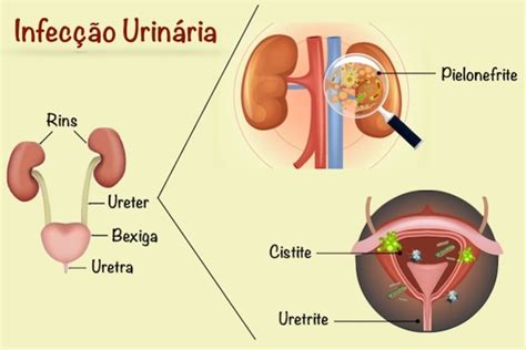 Conhe A Causas Inusitadas Da Infec O Urin Ria