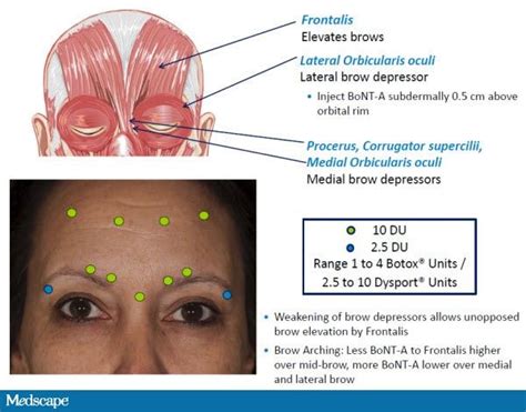 Brow Shaping Enhancement With Botulinum Neurotoxin Type A