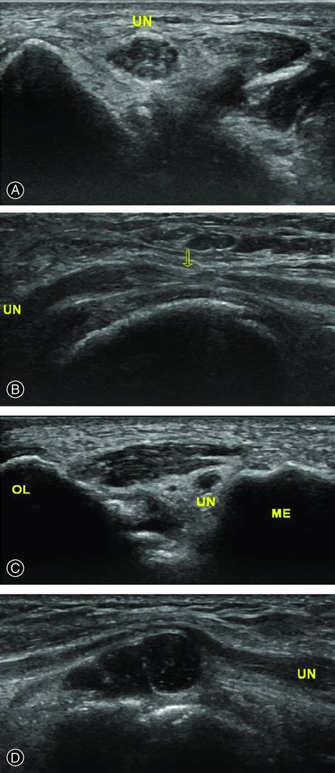 Ultrasound Measure Results Before The Operation A The Ulnar Nerve