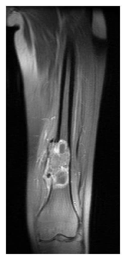 A Plain Radiograph Of The Left Distal Femur Demonstrates An Osteolytic