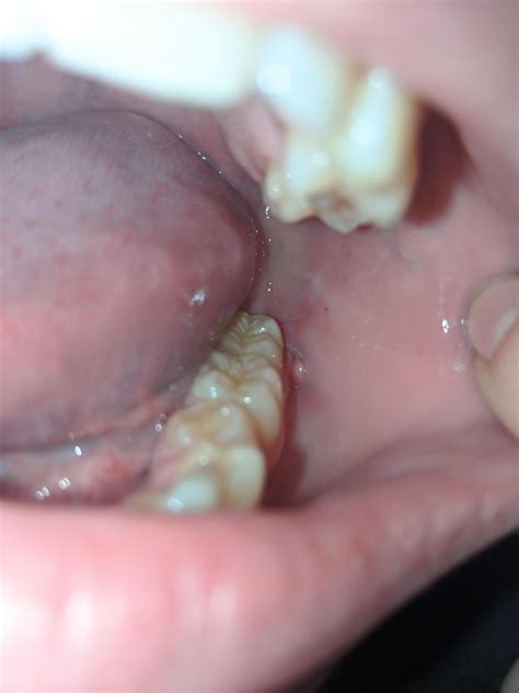 Got My Wisdom Teeth Removed 3 Weeks Ago Now There Is A Small Bump On