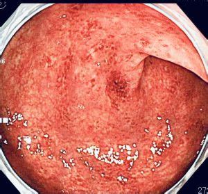 Definition of 潰瘍性大腸炎 in the definitions.net dictionary. バランスのよい食生活の継続で潰瘍性大腸炎を治療する - 福岡 ...