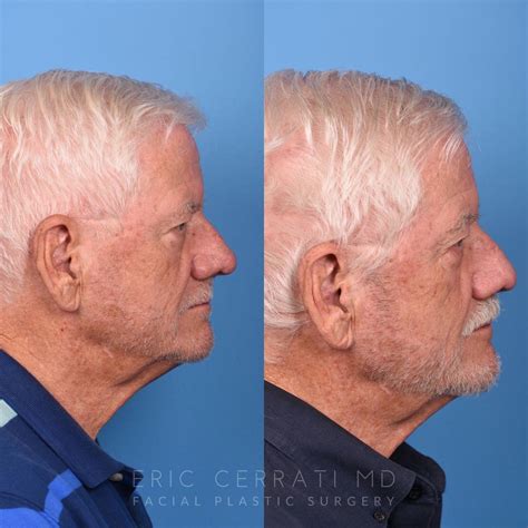 Salt Lake City Ut Facial Reconstructive Surgery Before And After Pictures