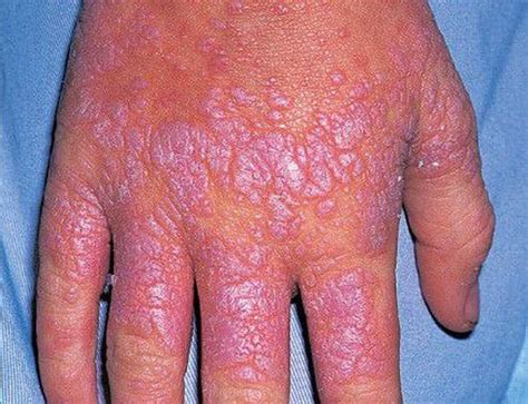 Lichen Planus Is An Uncommon Chronic Pruritic Inflammatory