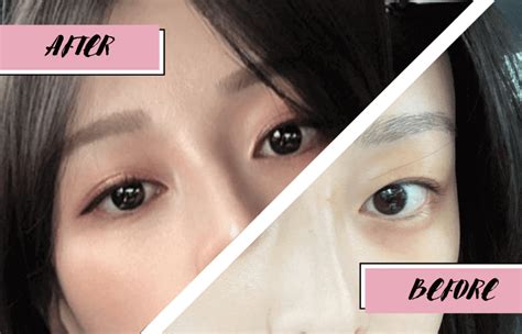 My Double Eyelid Surgery Review And Results Grace Chua