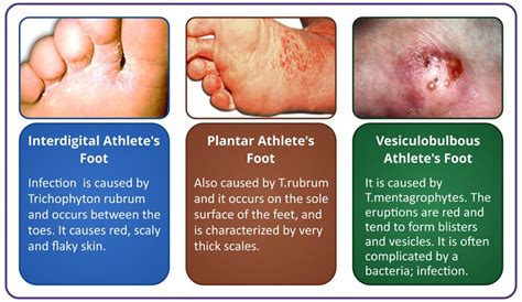 Athletesfoot Symptoms Learn About Symptoms Of Athletes Foot And