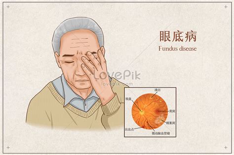 Fundus Disease Medical Illustration Illustration Imagepicture Free