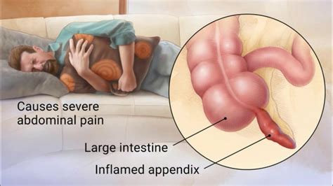 Informasi diagnostik yang didapat pada. Sakit Perut Belah Kanan: Appendisitis Atau Bukan? Ini ...