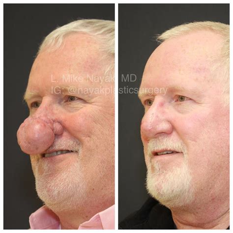 Before And After Rhinophyma Reduction Procedures In St Louis Mo Nayak