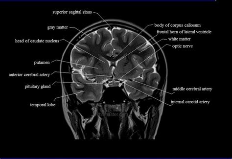 Brain Anatomy Mri Coronal Brain Anatomy Free Mri Cross Sectional