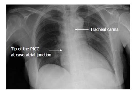 Focus On Peripherally Inserted Central Catheters In