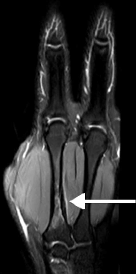 Mri In Spair In Axial Section Demonstrates The Swelling And Bone Edema