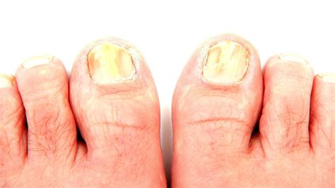 The fungal infection is usually diagnosed by numbness in the nose. How To Get Rid Of Yellow Toenail Fungus - Yellow Choices