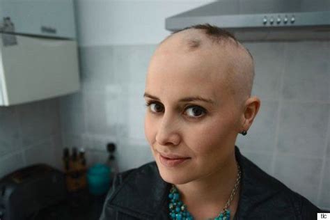 Woman With Alopecia Opens Up About The Difficulties Of Dating It Has